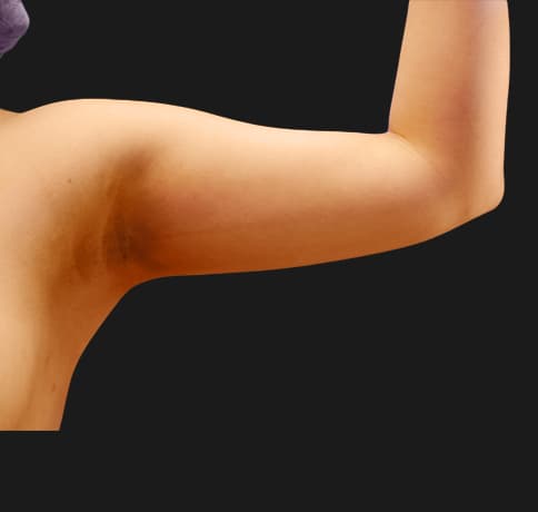 Case 16605, Performed By Dr. Tehrani – angle 3 After