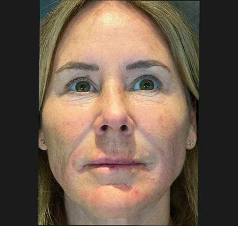 Case 17126, Performed By Dr. Tehrani – After