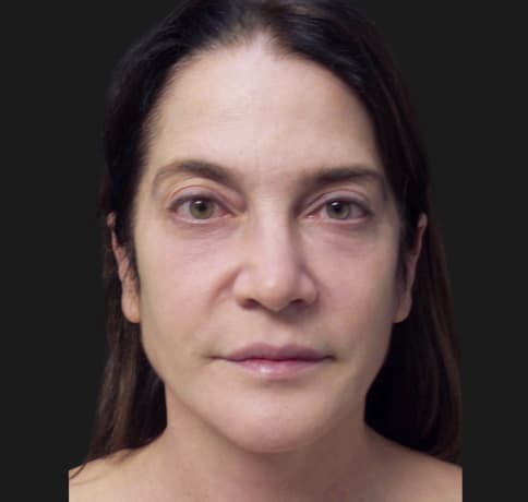 Case 53747, Performed By Dr. Tehrani – Before