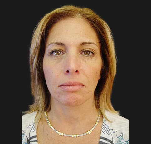 Case 15915, Performed By Dr. Tehrani – After