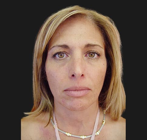 Case 15915, Performed By Dr. Tehrani – Before