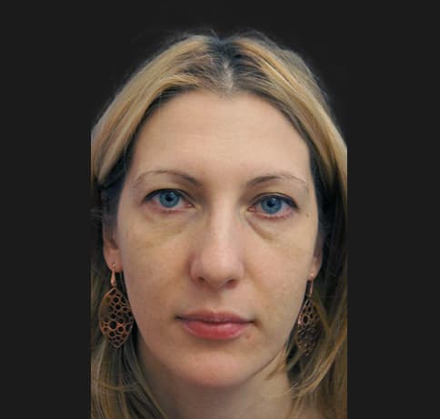 Case 17225 , Performed By Dr. Tehrani – Before
