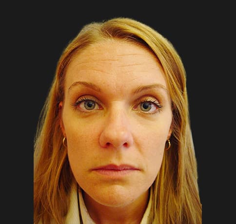 Case 7442, Performed By Dr. Tehrani – Before