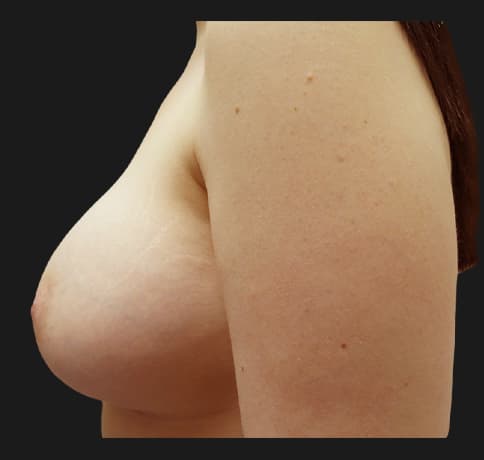 Case 30339, Performed By Dr. Tehrani – angle 3 After