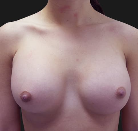 Case 31775, Performed By Dr. Tehrani – After