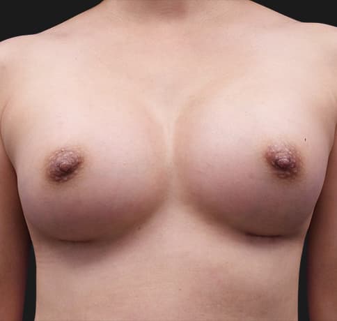 Case 33569, Performed By Dr. Tehrani – After