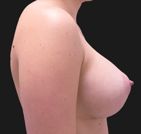 Case 33106, Performed By Dr. Tehrani – angle 2 After