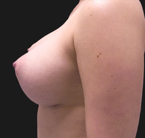 Case 33106, Performed By Dr. Tehrani – angle 3 After