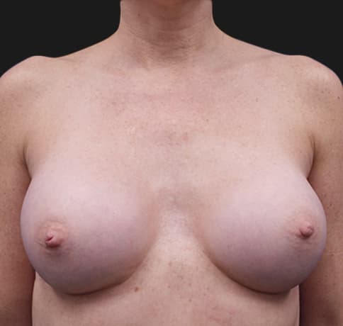 Case 32910, Performed By Dr. Tehrani – After