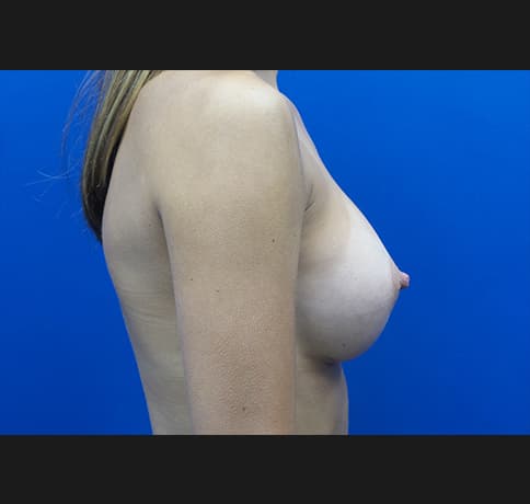 Case 35863, Performed By Dr. Tehrani – angle 2 After