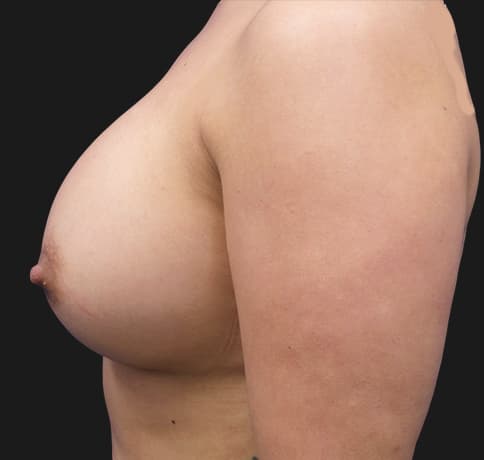 Case 36820 , Performed By Dr. Tehrani – angle 4 After