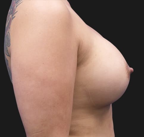 Case 36820 , Performed By Dr. Tehrani – angle 5 After