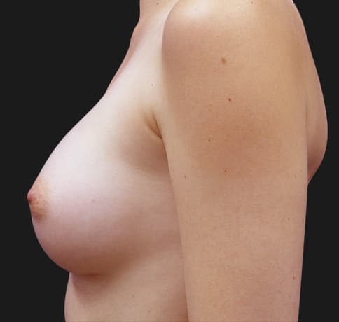 Case 35559, Performed By Dr. Tehrani – angle 3 After
