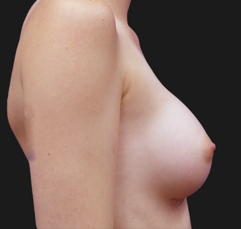 Case 35559, Performed By Dr. Tehrani – angle 2 After
