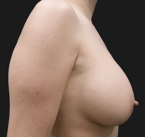 Case 17742, Performed By Dr. Tehrani – angle 5 After