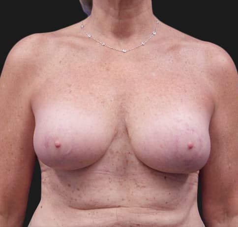 Case 36835 , Performed By Dr. Tehrani – After