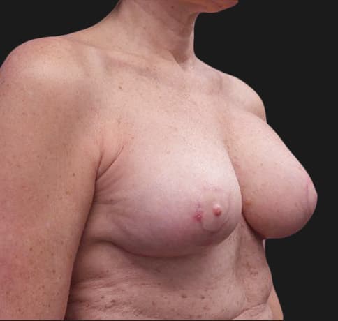 Case 36835 , Performed By Dr. Tehrani – After