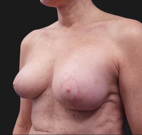 Case 36835 , Performed By Dr. Tehrani – angle 3 After