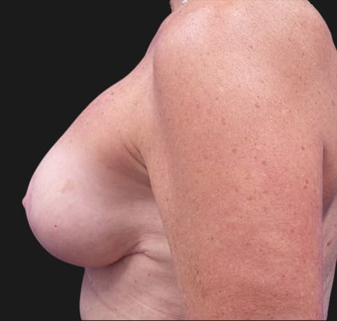 Case 36835 , Performed By Dr. Tehrani – angle 4 After