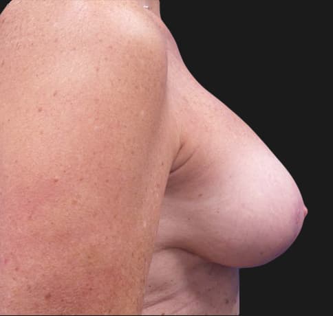 Case 36835 , Performed By Dr. Tehrani – angle 5 After