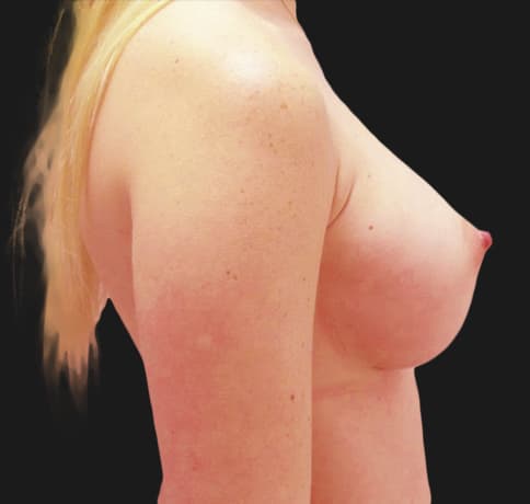 Case 36917, Performed By Dr. Tehrani – angle 4 After