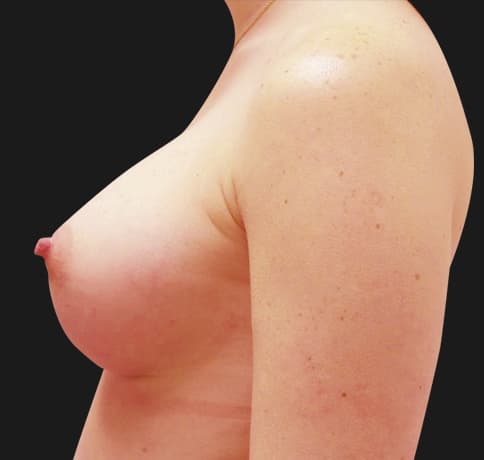 Case 36917, Performed By Dr. Tehrani – angle 5 After