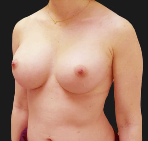 Case 36917, Performed By Dr. Tehrani – angle 3 After