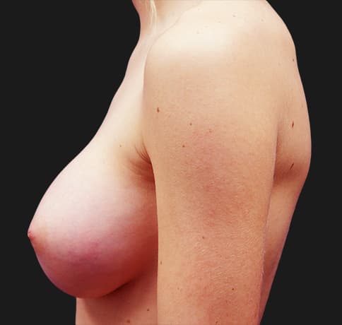 Case 16185, Performed By Dr. Tehrani – angle 4 After