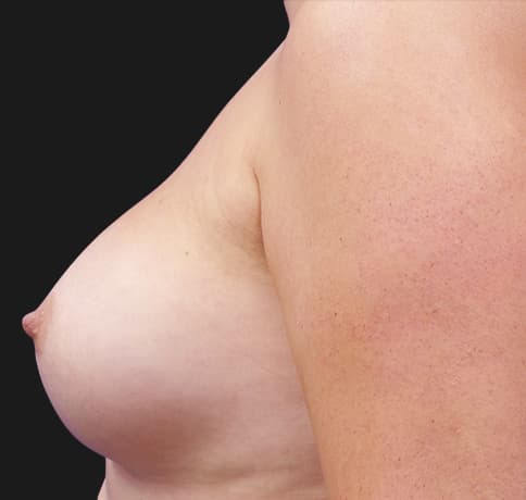Case 37609, Performed By Dr. Tehrani – angle 4 After