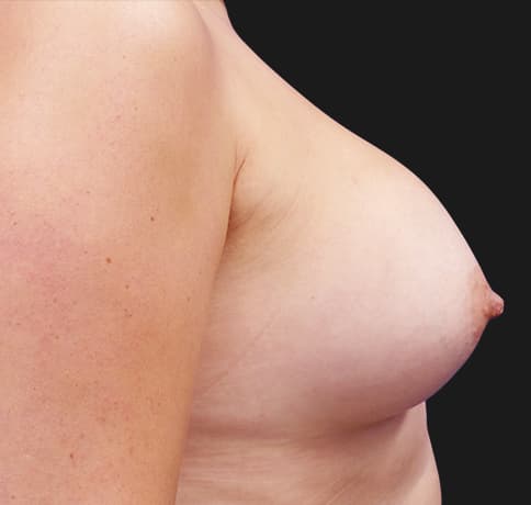 Case 37609, Performed By Dr. Tehrani – angle 5 After