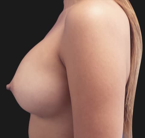 Case 37344, Performed By Dr. Tehrani – angle 4 After