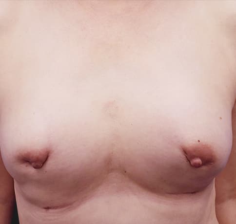 Case 38560 , Performed By Dr. Tehrani – After
