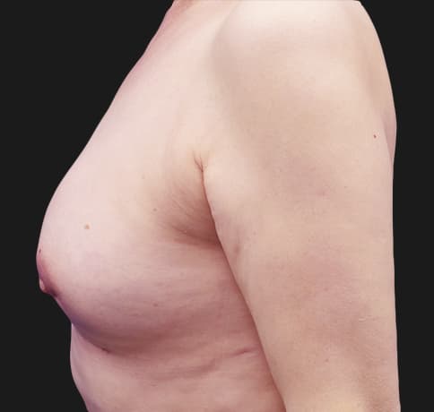 Case 38560 , Performed By Dr. Tehrani – angle 4 After