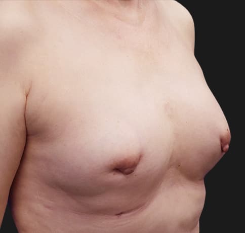 Case 38560 , Performed By Dr. Tehrani – After