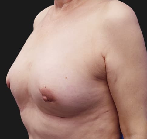 Case 38560 , Performed By Dr. Tehrani – angle 3 After