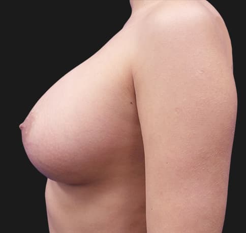 Case 36549 , Performed By Dr. Tehrani – angle 2 After