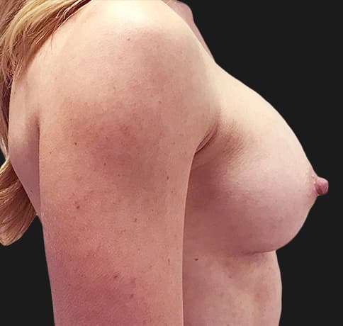 Case 38527 , Performed By Dr. Tehrani – angle 4 After