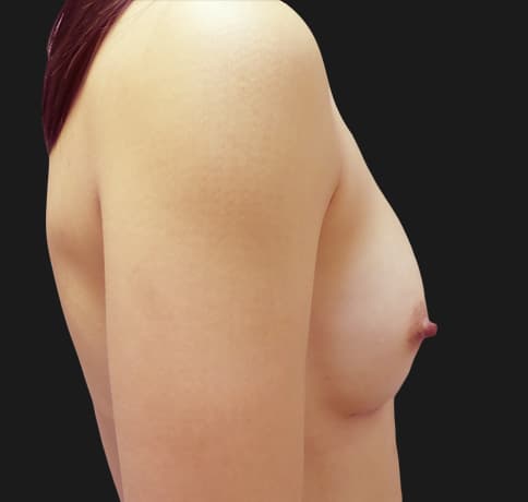 Case 39179 , Performed By Dr. Tehrani – angle 4 After