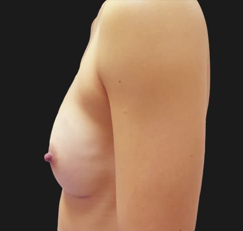 Case 39179 , Performed By Dr. Tehrani – angle 5 After
