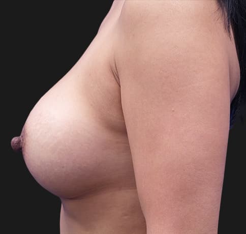 Case 41371, Performed By Dr. Tehrani – angle 5 After
