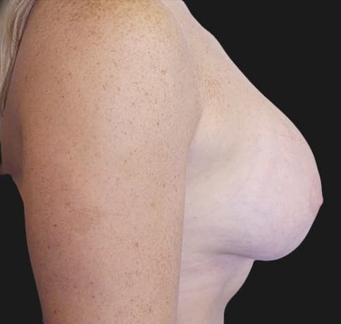 Case 33048, Performed By Dr. Tehrani – angle 4 After