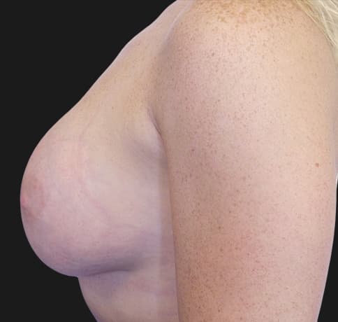 Case 33048, Performed By Dr. Tehrani – angle 5 After