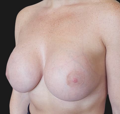 Case 33048, Performed By Dr. Tehrani – angle 3 After