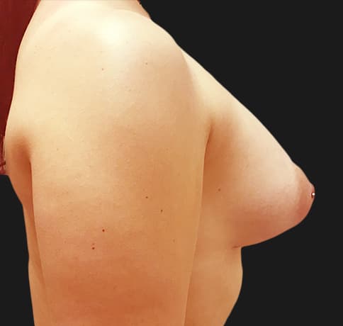 Case 41461, Performed By Dr. Tehrani – angle 2 After