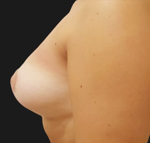 Case 41461, Performed By Dr. Tehrani – angle 3 After