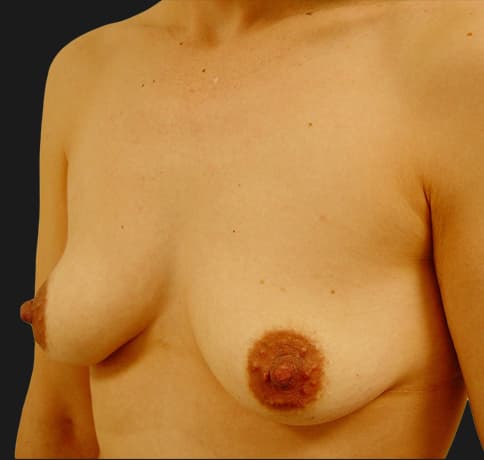 Case 6268, Performed By Dr. Tehrani – angle 3 Before