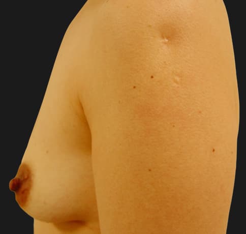 Case 6268, Performed By Dr. Tehrani – angle 4 Before