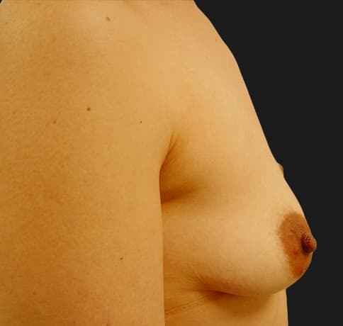 Case 6268, Performed By Dr. Tehrani – angle 5 Before