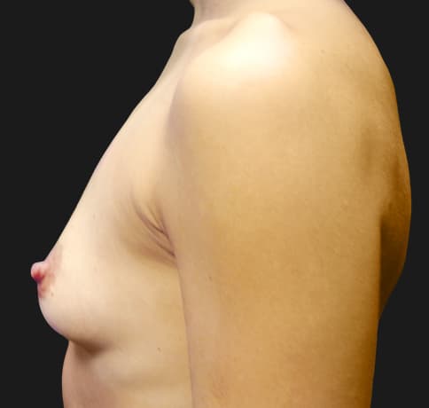 Case 12221, Performed By Dr. Tehrani – angle 4 Before