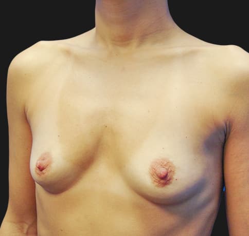 Case 12221, Performed By Dr. Tehrani – angle 3 Before